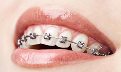 ORTHODONTIC BASICS - TYPES OF BRACES - self ligating